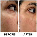 Cellovia microneedle eye patches before and after comparison showing reduced fine lines and brighter under-eye skin.